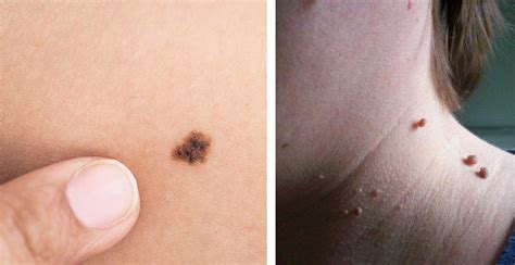15 ways to naturally cure skin tags age spots moles