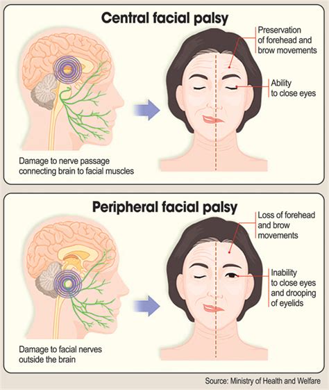 central facial nerve palsy sexy women