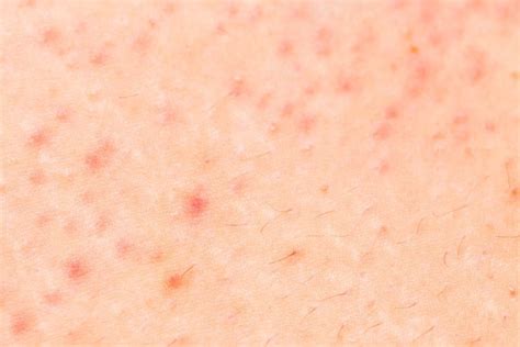 skin conditions that look like acne—but aren t the healthy