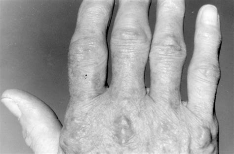 “rheumatoid nodules” and lymphoma annals of the rheumatic diseases