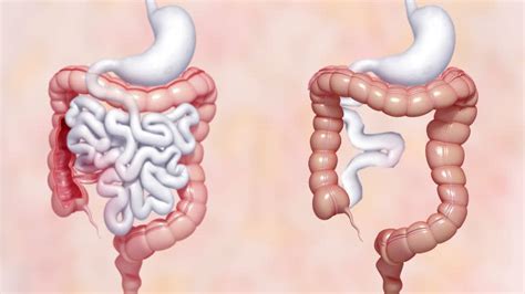 optimize outcomes  patients  short bowel syndrome american