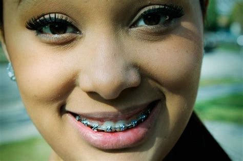 beauty of blue braces teeth braces ideas dental braces