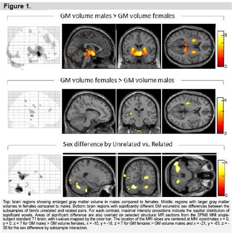 Sex Differences In Gray And White Matter Structure In Age Matched