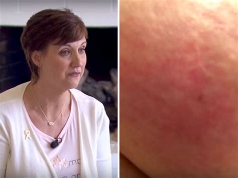 woman shares photo of inflammatory breast cancer symptom in hope it ll save lives