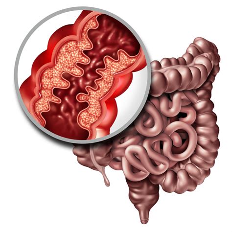 understanding crohns disease  overview gastroenterology health