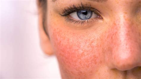 Itch Or Non Itchy Red Face Rash Causes And Treatments