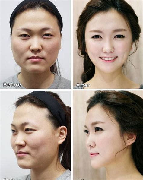 South Korean Plastic Surgery Patients Need New Id To Prove Who They Are