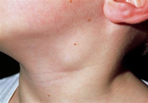 lymph node lump  neck