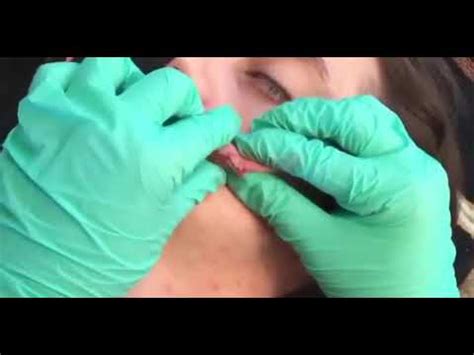 removal cyst  sac subscribe youtube