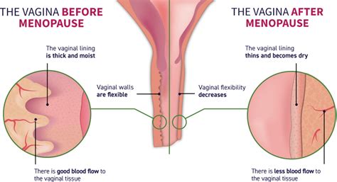 Painful Sex After Menopause Vulvar And Vaginal Atrophy Vva