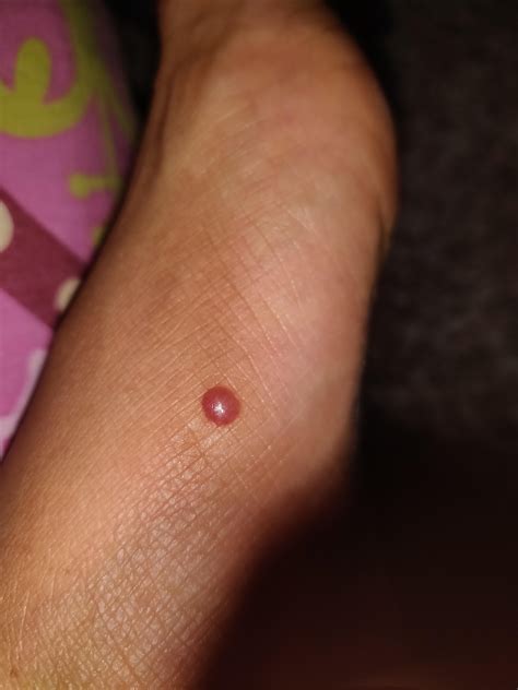 What Kind Of Bug Bite Bites On Legs Turning To Blisters