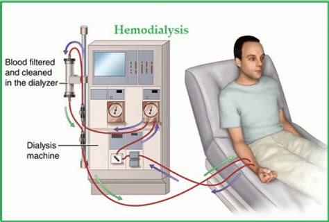 treating chronic kidney disease  dialysis premier surgical associates