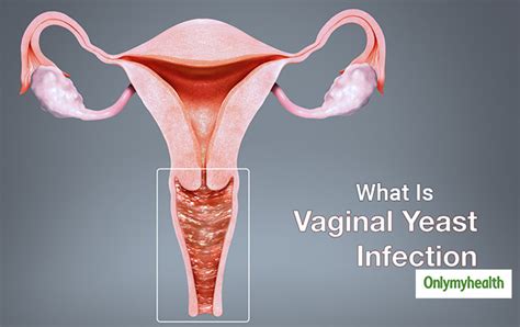 What Is Vaginal Yeast Infection Know Causes And Risks From Doctor