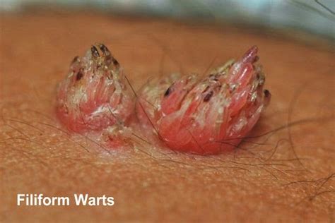 pictures of vagenital warts on anal