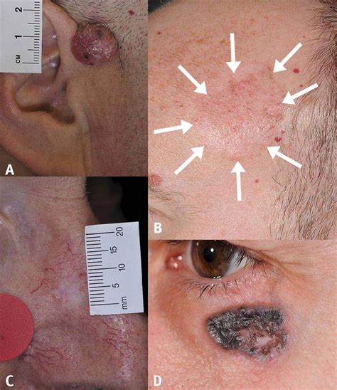 carcinoma skin cancer types basal cell carcinoma bcc