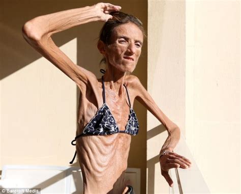 Frightening Words Of 4st Anorexic Valeria Levitin Who Gets Fan Mail