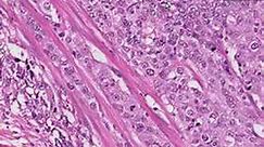 Histopathology Urinary bladder--Transitional cell carcinoma