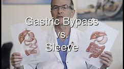 Gastric Bypass vs Sleeve, update for 2021