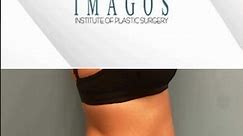Amazing Before and After Tummy Tuck Results