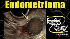 Endometrioma || Chocolate Cyst || TVS || Ultrasound || Case 263