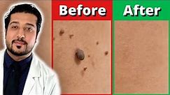 How to Rid Skin Tags FASTER | 3 Easy Skin Tag Removal Steps