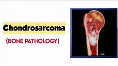 Chondrosarcoma/Bone pathology/Robbins pathology/bone tumor/forward focused
