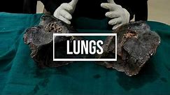 Lungs - gross anatomy