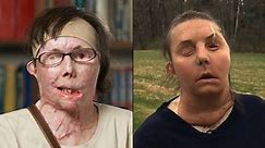 Woman reveals face transplant