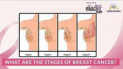 What are the stages of breast cancer