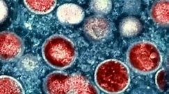 Mpox cases rising in Chicago area