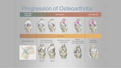 Total Knee Replacement with Mako Robotic-Arm - Florida Orthopaedic Institute, Dr. Michael Miranda