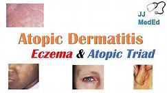 Eczema (Atopic Dermatitis) | Atopic Triad, Triggers, Who gets it, Why does it happen, & Treatment
