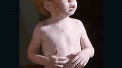 Why are measles cases on the rise?