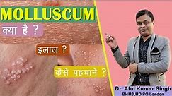 molluscum contagiosum | Treatment of Molluscum contagiosum | Homeopathic treatment of Molluscum