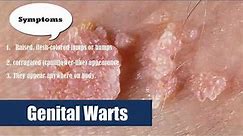 16# Genital Warts HPV Human Papilloma Virus in Women and men symptoms
