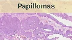 What are Papillomas? - Pathology mini tutorial