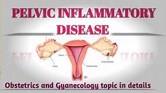 Learn Pelvic inflammatory disease risk factor ,causes,symptoms and treatment in details
