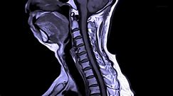 Neuroscience Breakthrough Could Lead to New Treatments for Spinal Cord Injuries - video Dailymotion