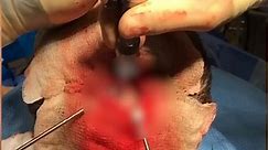 Plastic surgeon cuts into man's skull in graphic video