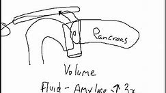 Whipple Procedure: What Is a Pancreatic Fistula?