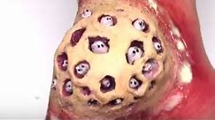 Real-Life Trypophobia Cyst! Unbelievable
