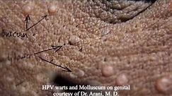 Molluscum contagiosum vs HPV warts on same patient combination infection