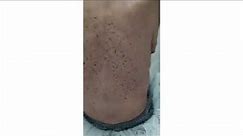 Sign Of Leser-Trélat | Skin Marker Of Internal Malignancy