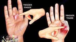 Trigger Finger & Trigger Thumb - Everything You Need To Know - Dr. Nabil Ebraheim