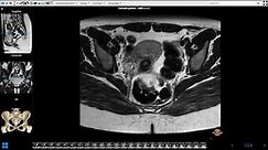 Female Pelvis MRI
