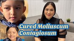 How we cured/treated molluscum contagiosum update 2021 ! How to get rid of molluscum contagiosum