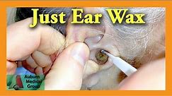 Ear Wax Removal Doctor | Auburn Medical Group
