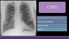 Black lung field: COPD, Pneumothorax & Bullae on Chest X-ray