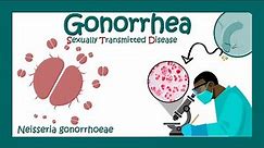 Gonorrhea: Signs & Symptoms | Neisseria gonorrhoeae | Diagnosis and Treatment of Gonorrhea | USMLE