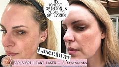 LASERAWAY CLEAR & BRILLIANT LASER RESULTS|| Honest Review PORES, DARK SPOTS, LINES 🌿🍁